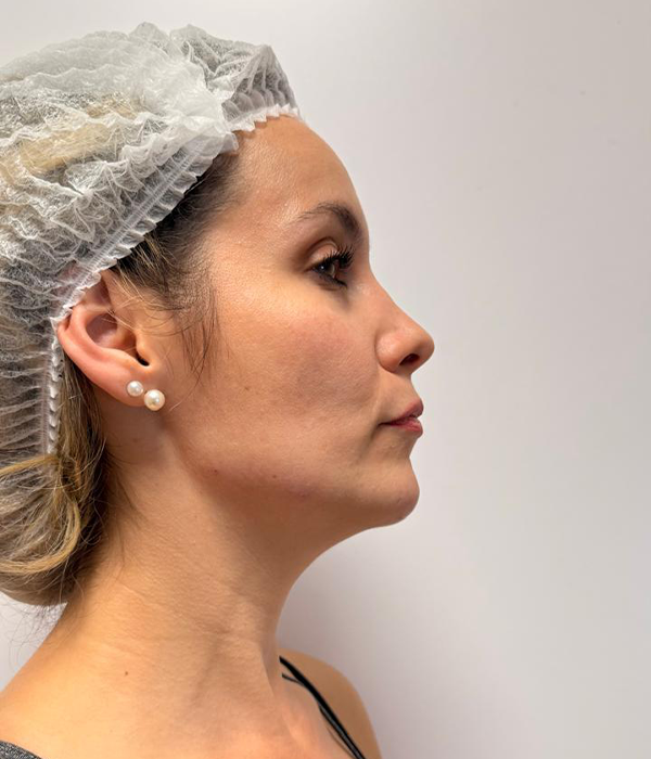 Después: contorno facial